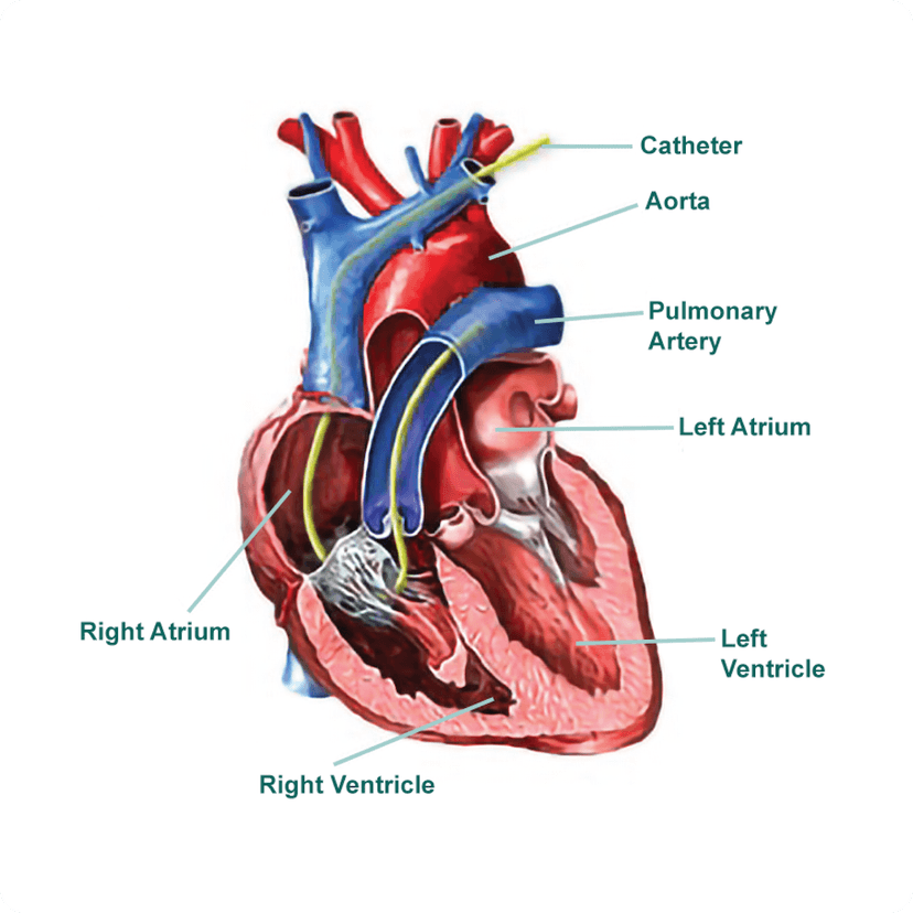 A view of right heart catheterization